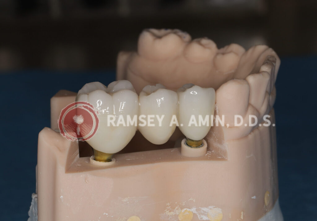 Lower right dental implant 3 tooth bridge -Ramsey Amin, DDS