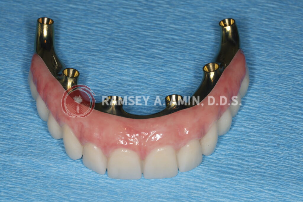 Upper all on 6 zirconia bridge with titanium framework substructure -Ramsey Amin, DDS