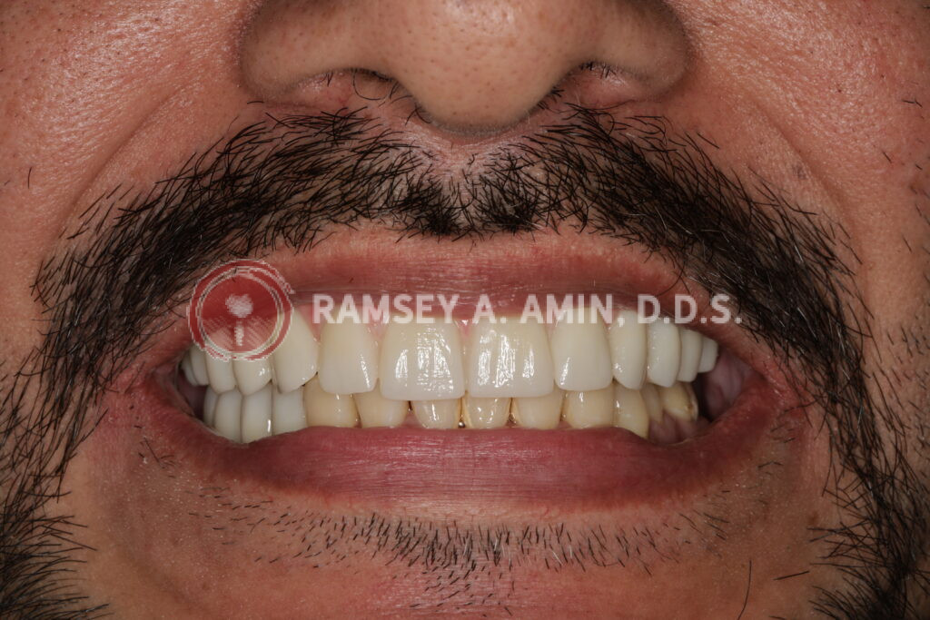 Natural appearance smile of full upper, and lower right dental implant bridge