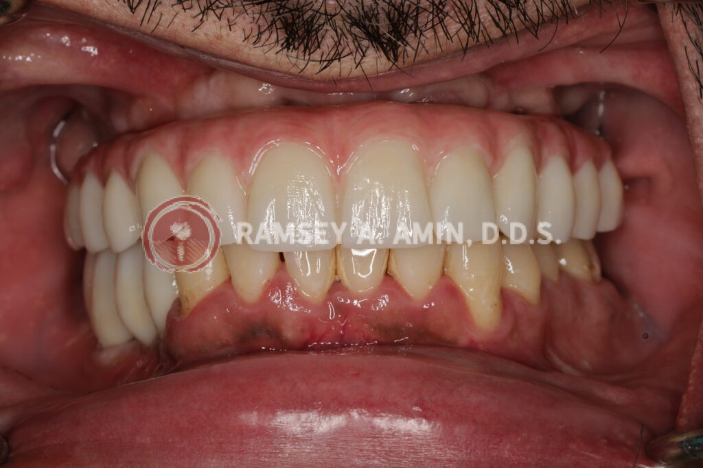 natural appearance smile of full upper, and lower right dental implant bridge
