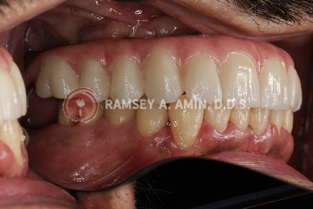 Side view - natural appearance smile of full upper, and lower right dental implant bridge