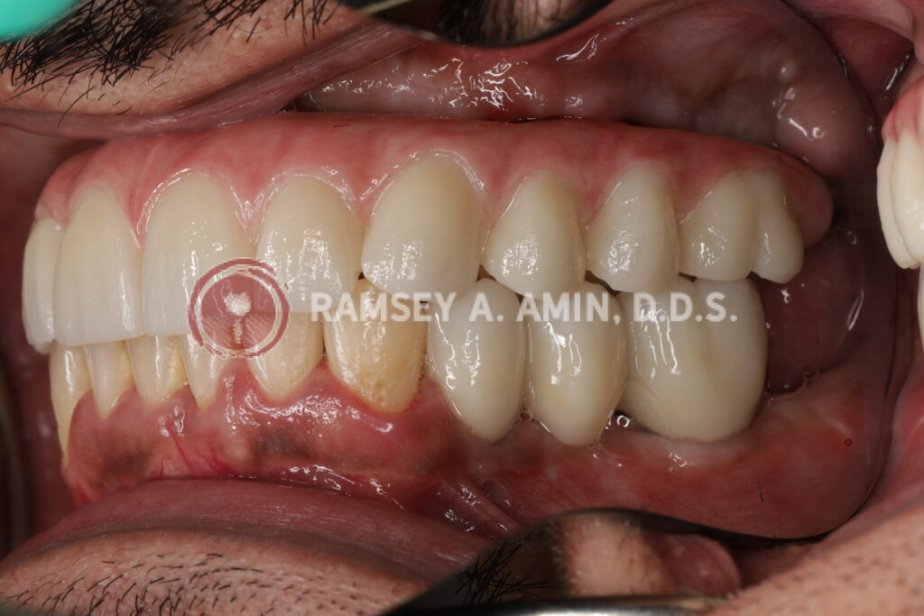 Side view - natural appearance smile of full upper, and lower right dental implant bridge