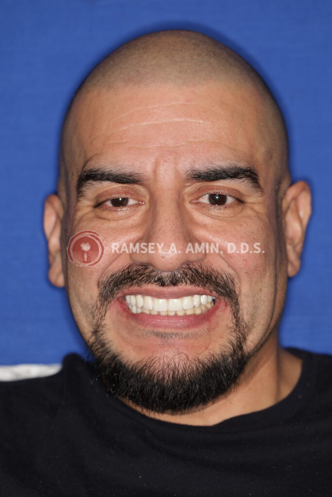 Natural appearance smile of full upper, and lower right dental implant bridge