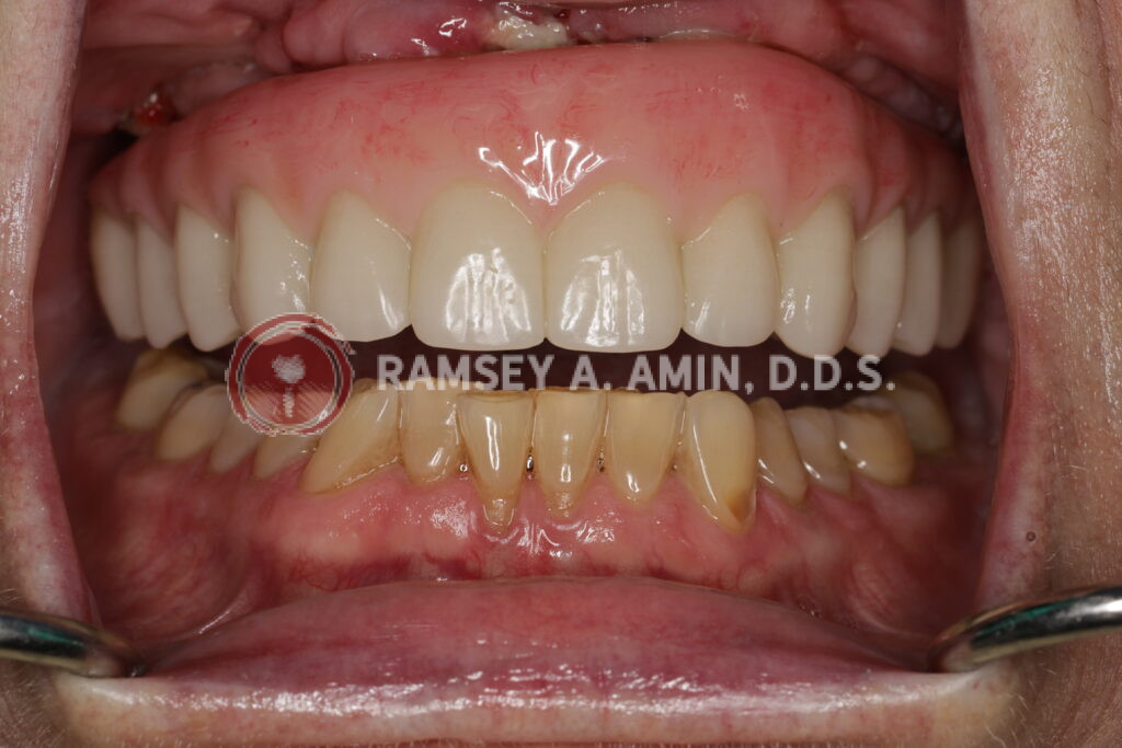 full arch dental implants by Ramsey Amin DDS of Burbank Dental Implants
