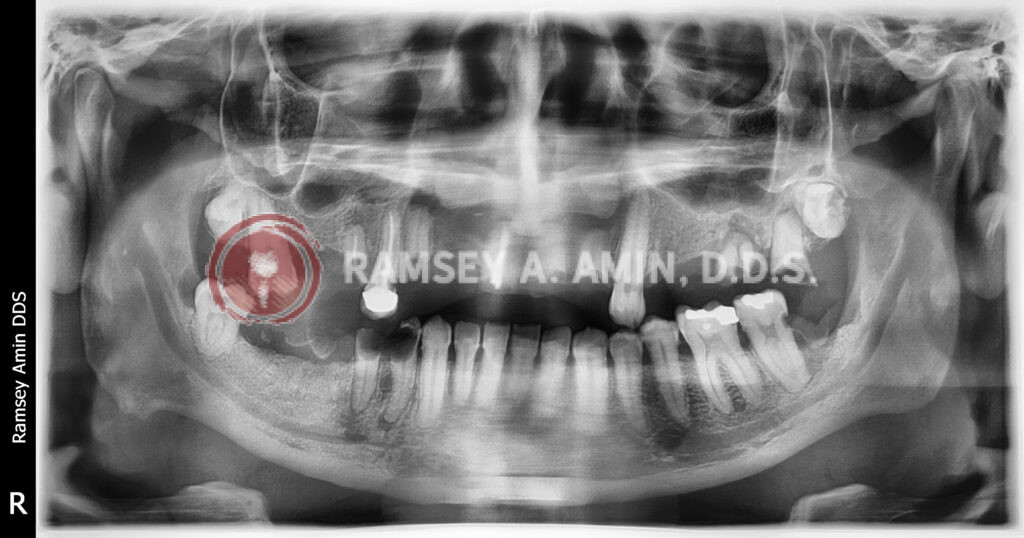 Dental panoramic x-ray showing severe decay and several bone infections