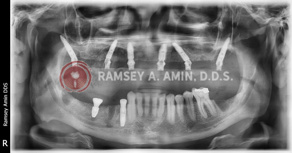 Next day x-ray after extractions and implants