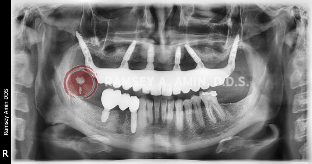 Dental panoramic x-ray -full upper all on 6 with pterygoids and lower right dental implant 3 tooth bridge -Ramsey Amin, DDS