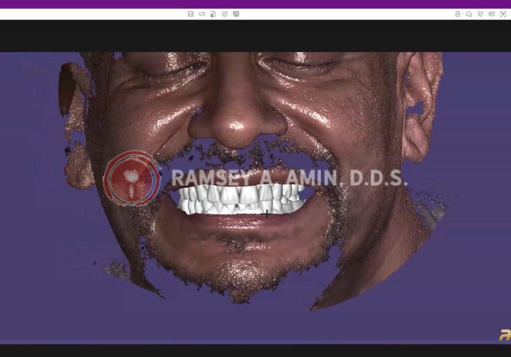 example of digital facial scanning technology to simulate a future smile - by Ramsey Amin, DDS