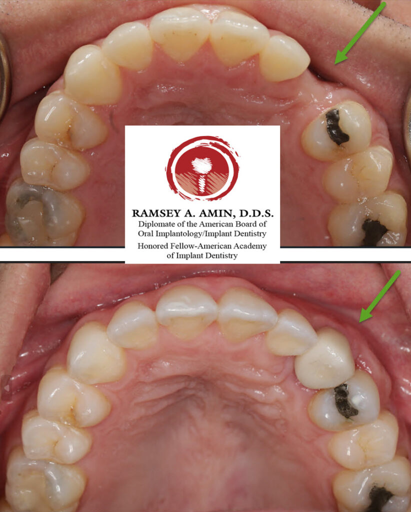 dental implant case using a block bone graft