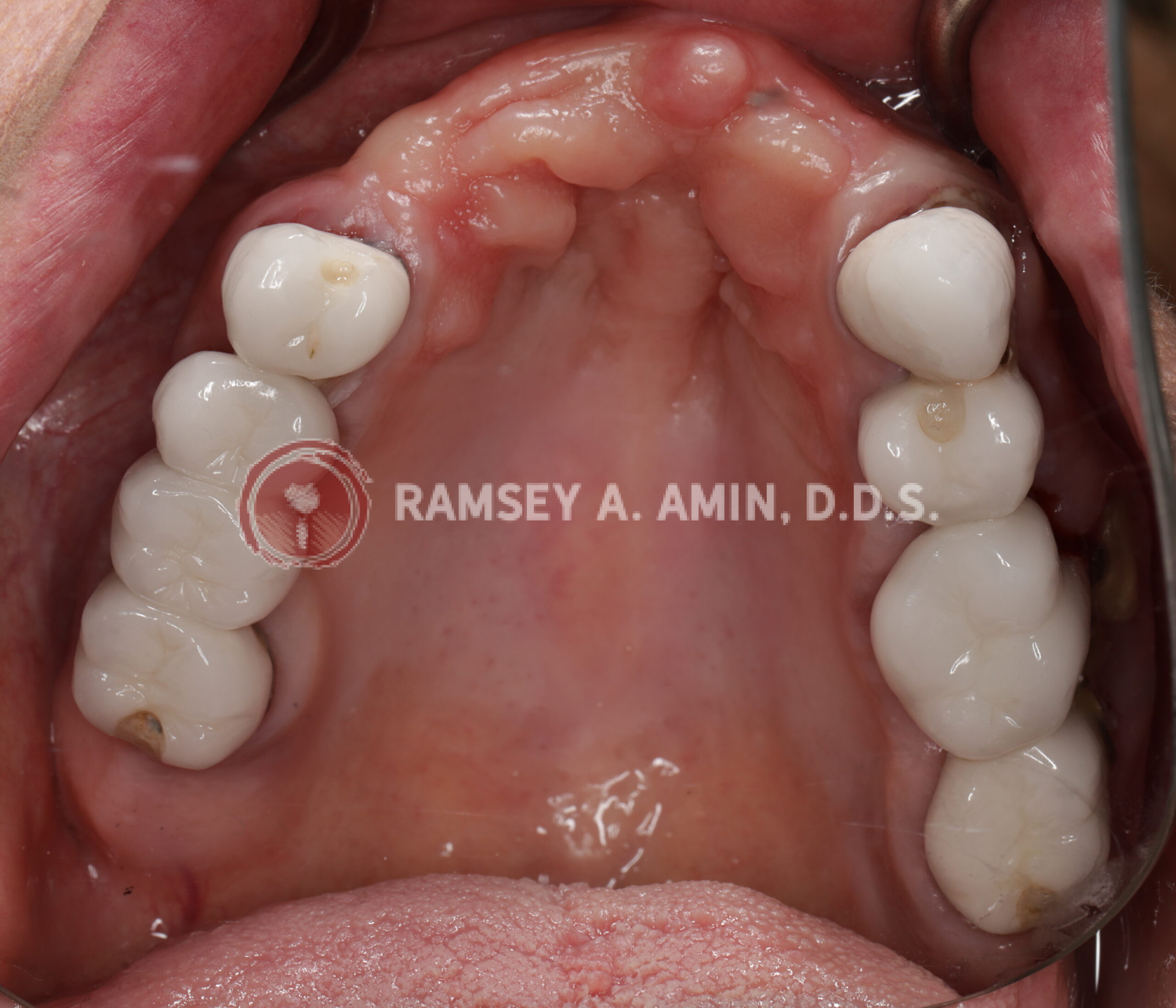 Before - upper jaw