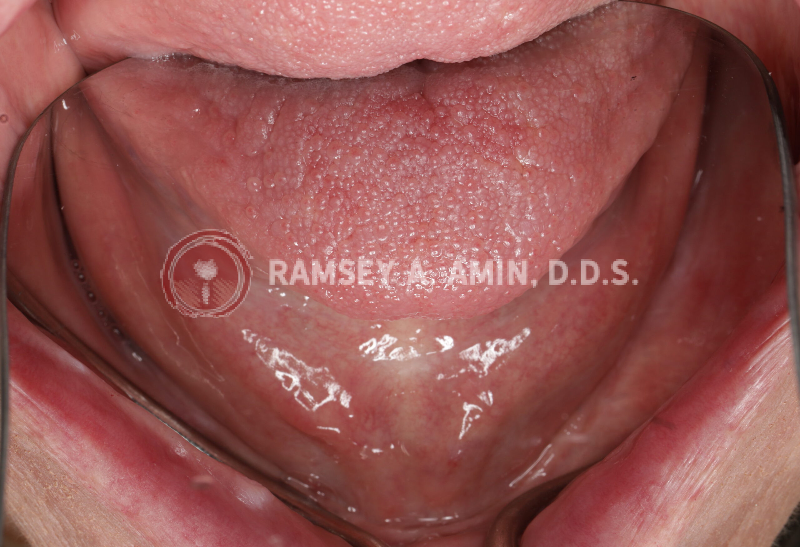 Before - lower jaw with no bone ridge