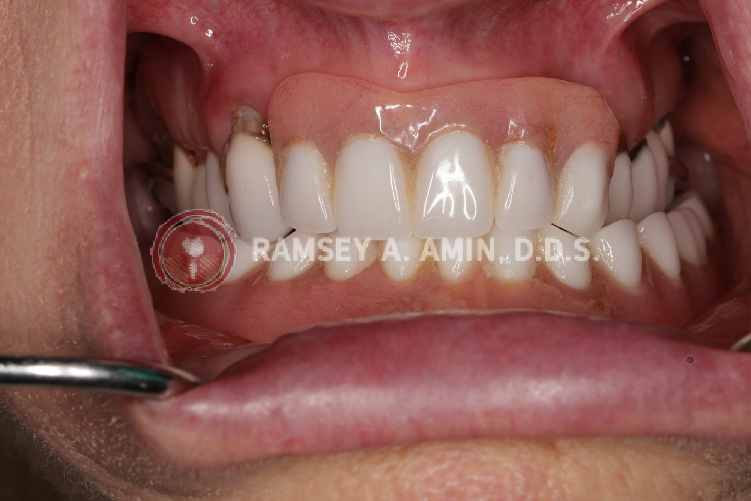 Before - with dentures