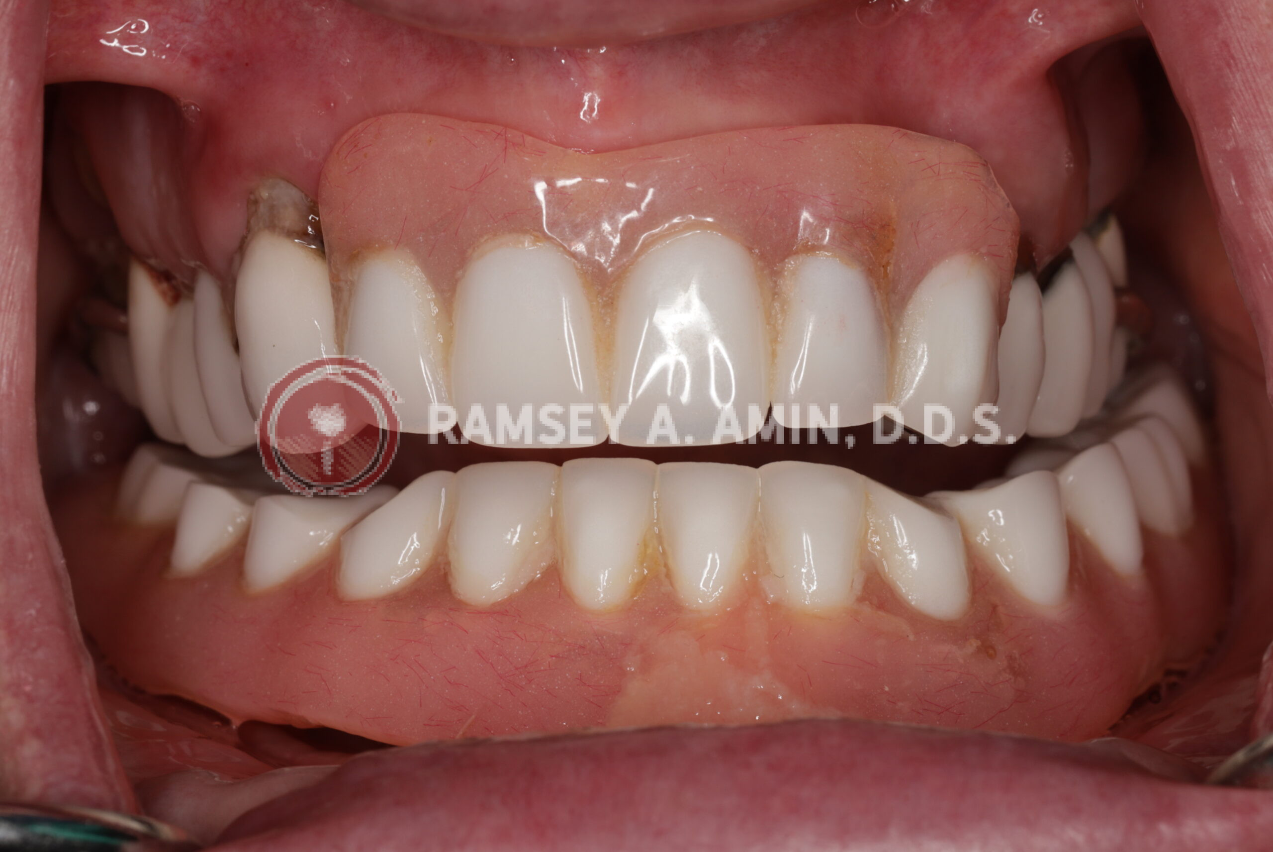 Before - with dentures