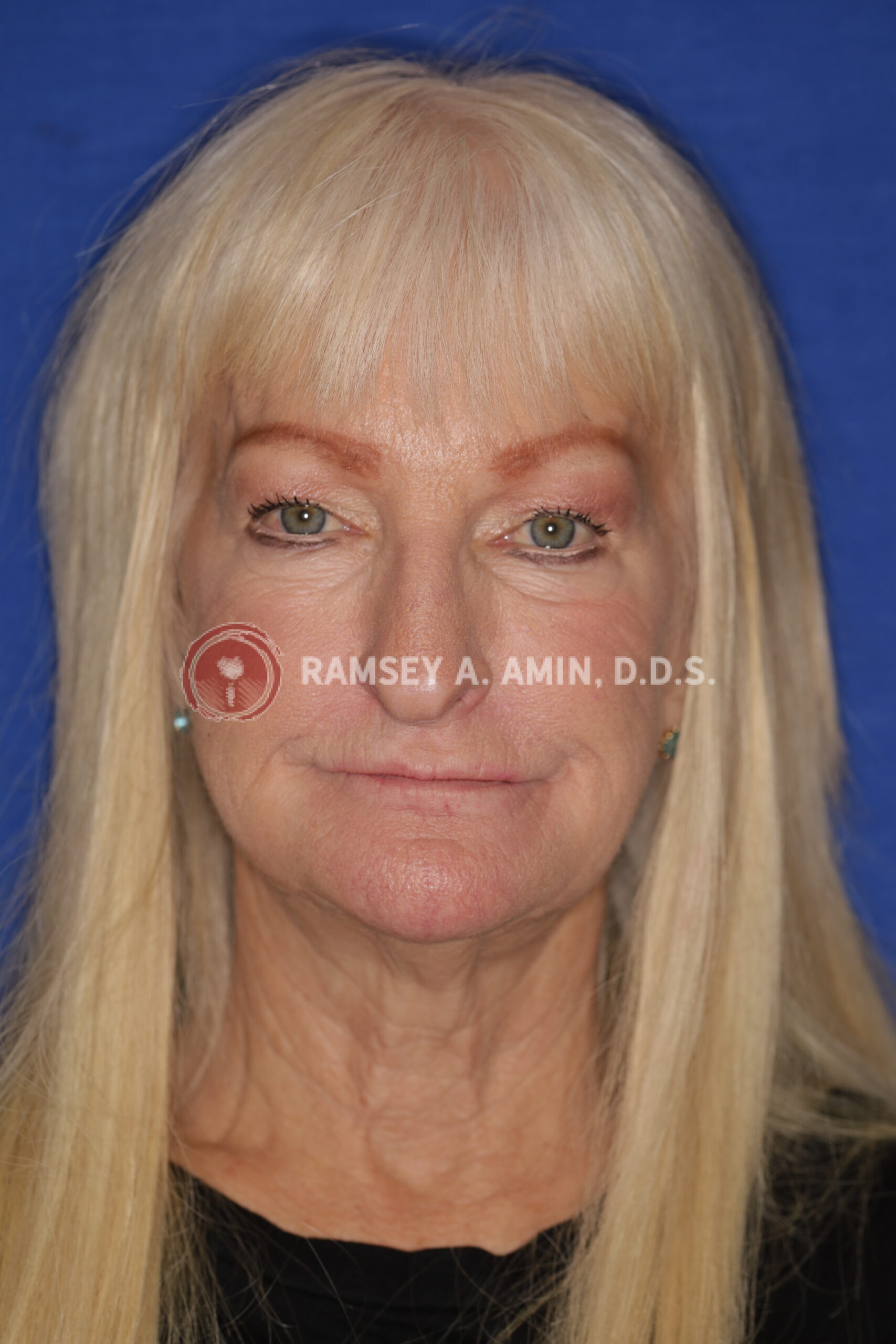Before - facial collapse