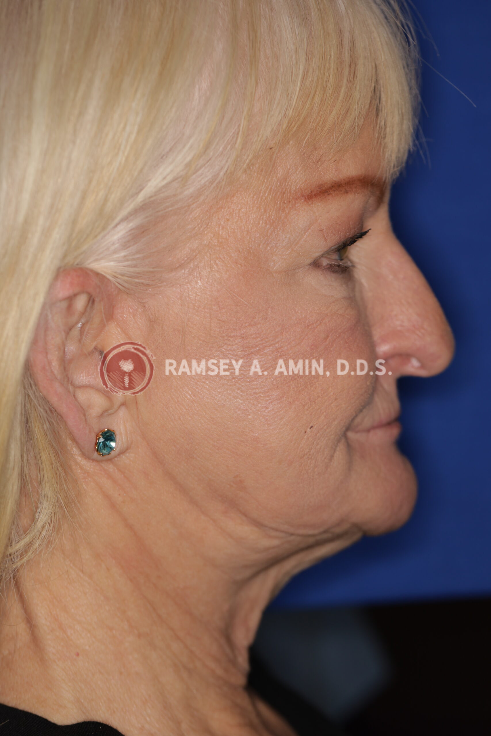 Before - facial collapse