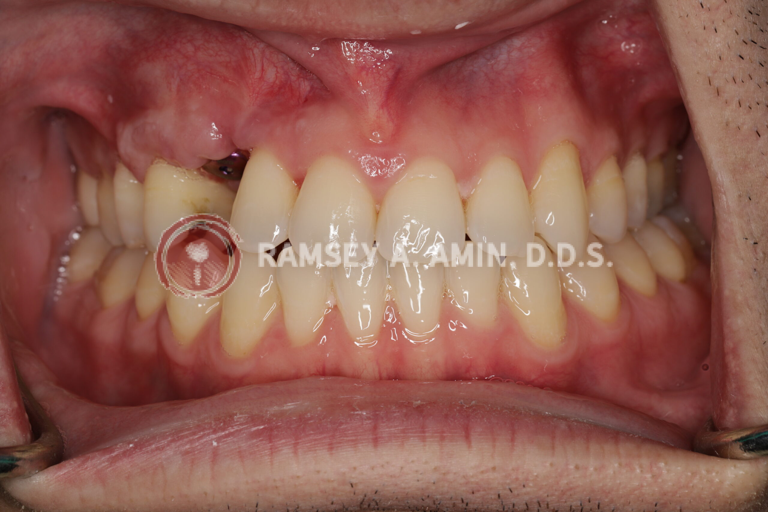 implant canine before gum shaping
