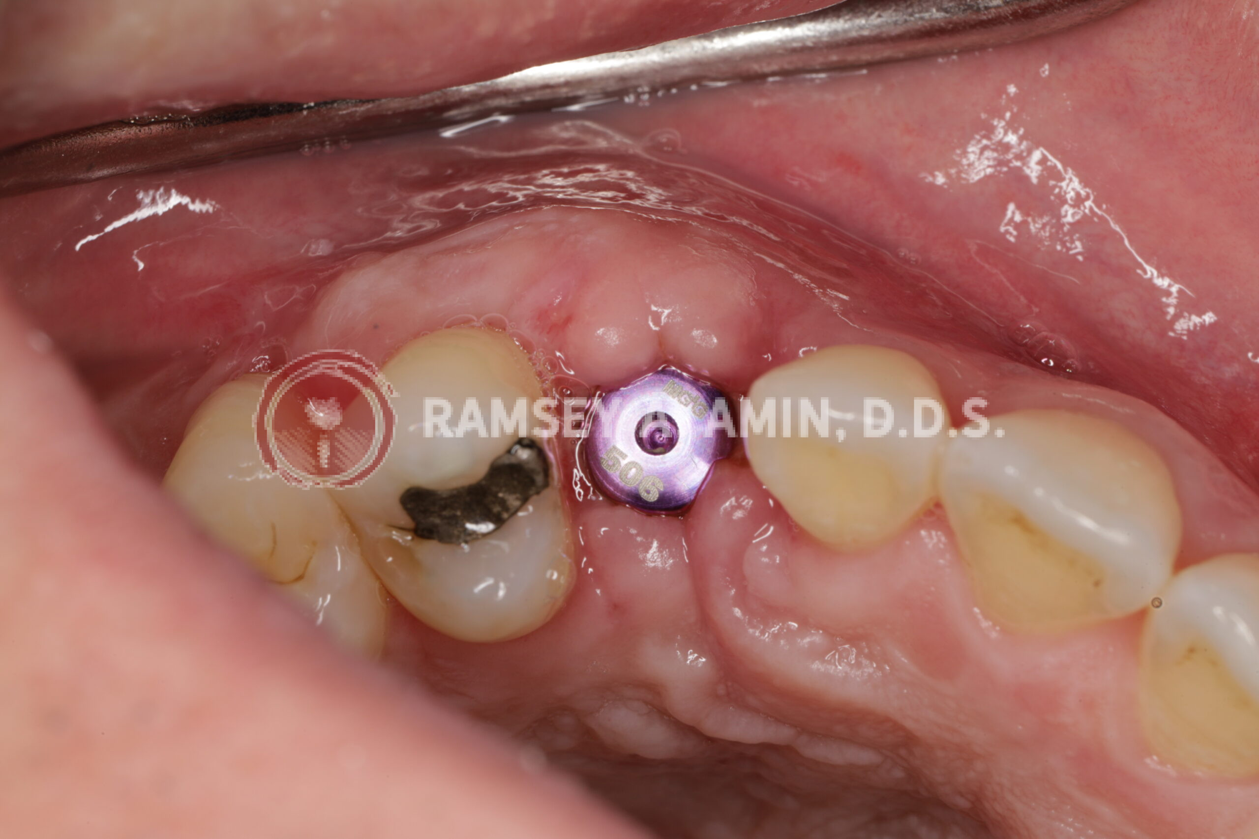 implant canine before gum shaping
