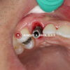 oval gum shape around the implant
