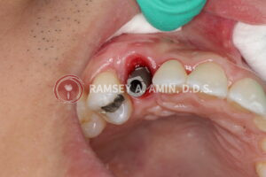 oval gum shape around the implant