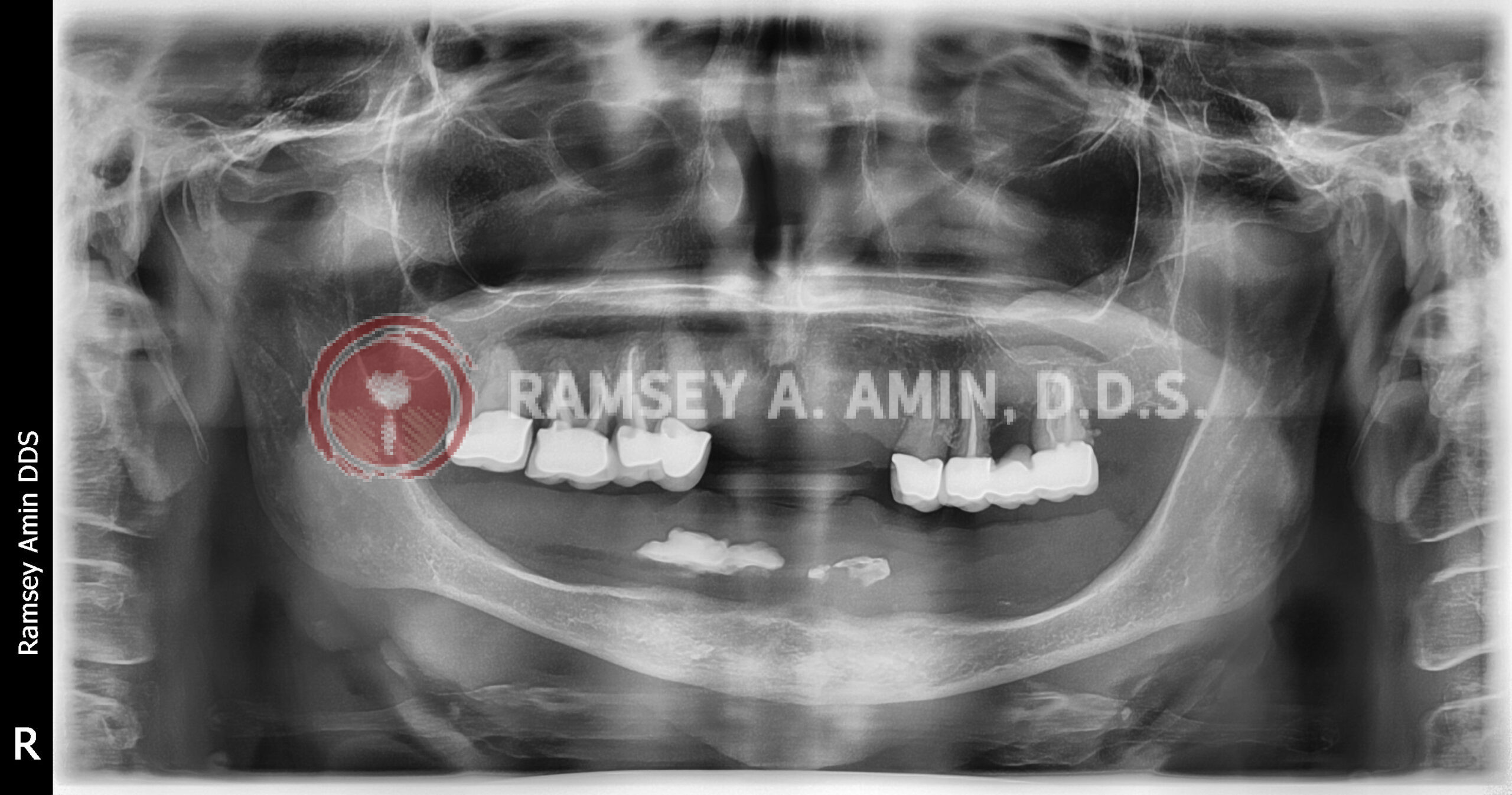 Preoperative panoramic x-ray showing very thin lower jaw and failing upper crown/bridges with root canals