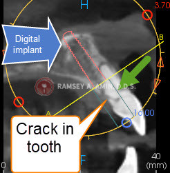 3D planning for front tooth implant using nasal rim if needed