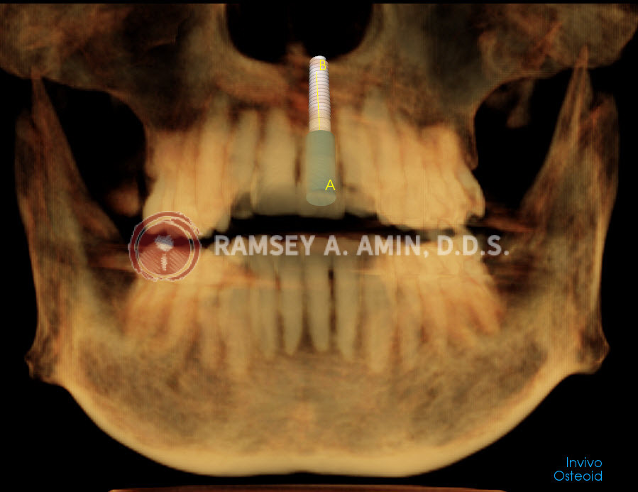 3D planning for front tooth implant using nasal rim if needed