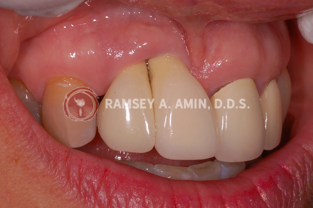 Bad dental implants missing gum triangle papillae