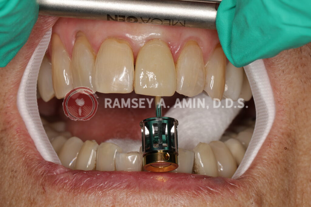 Final dental implant front tooth