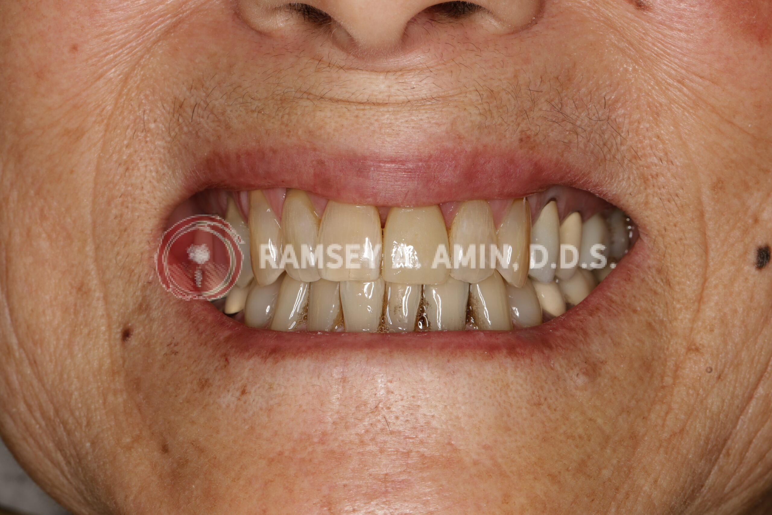 Final dental implant front tooth