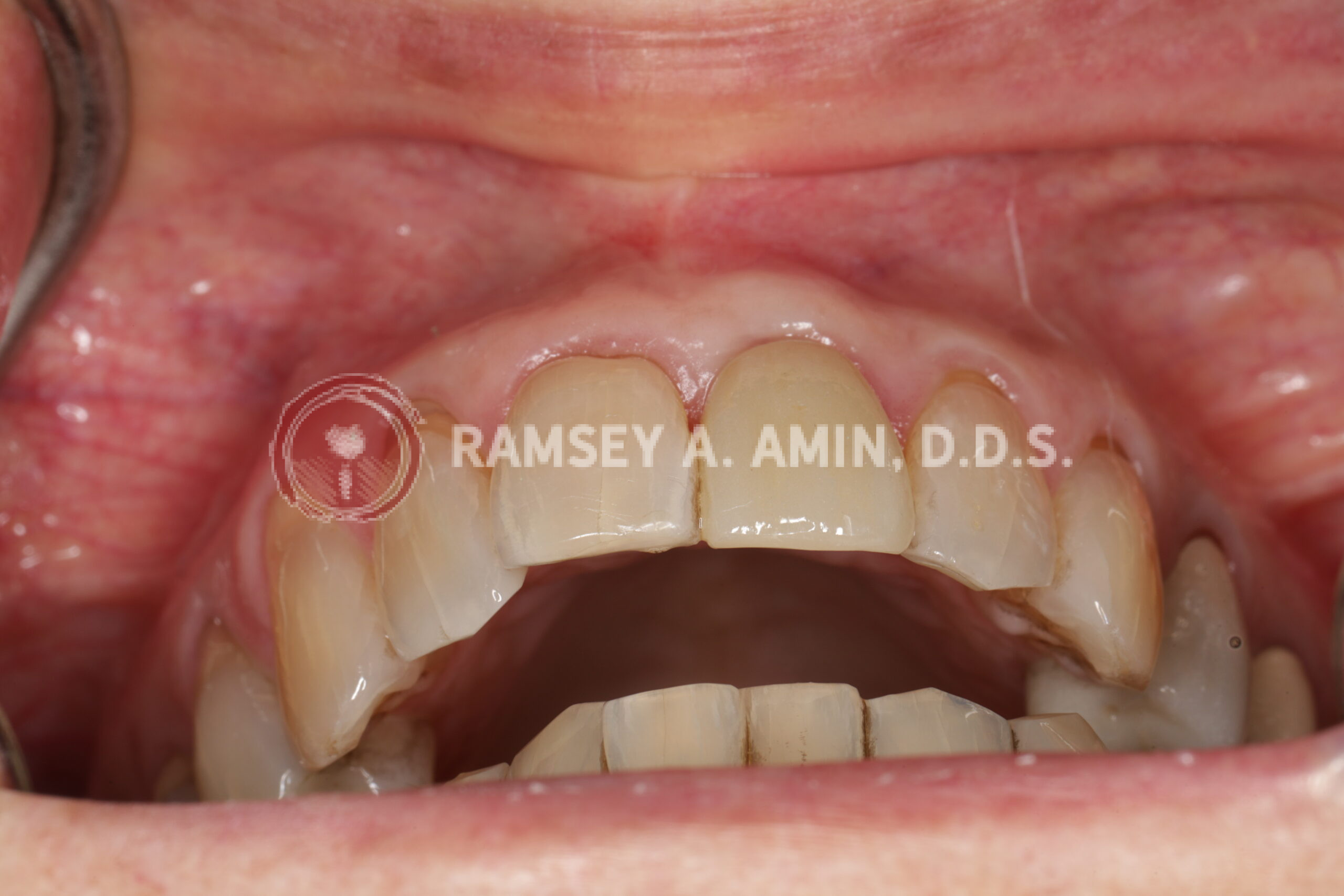 Final dental implant front tooth