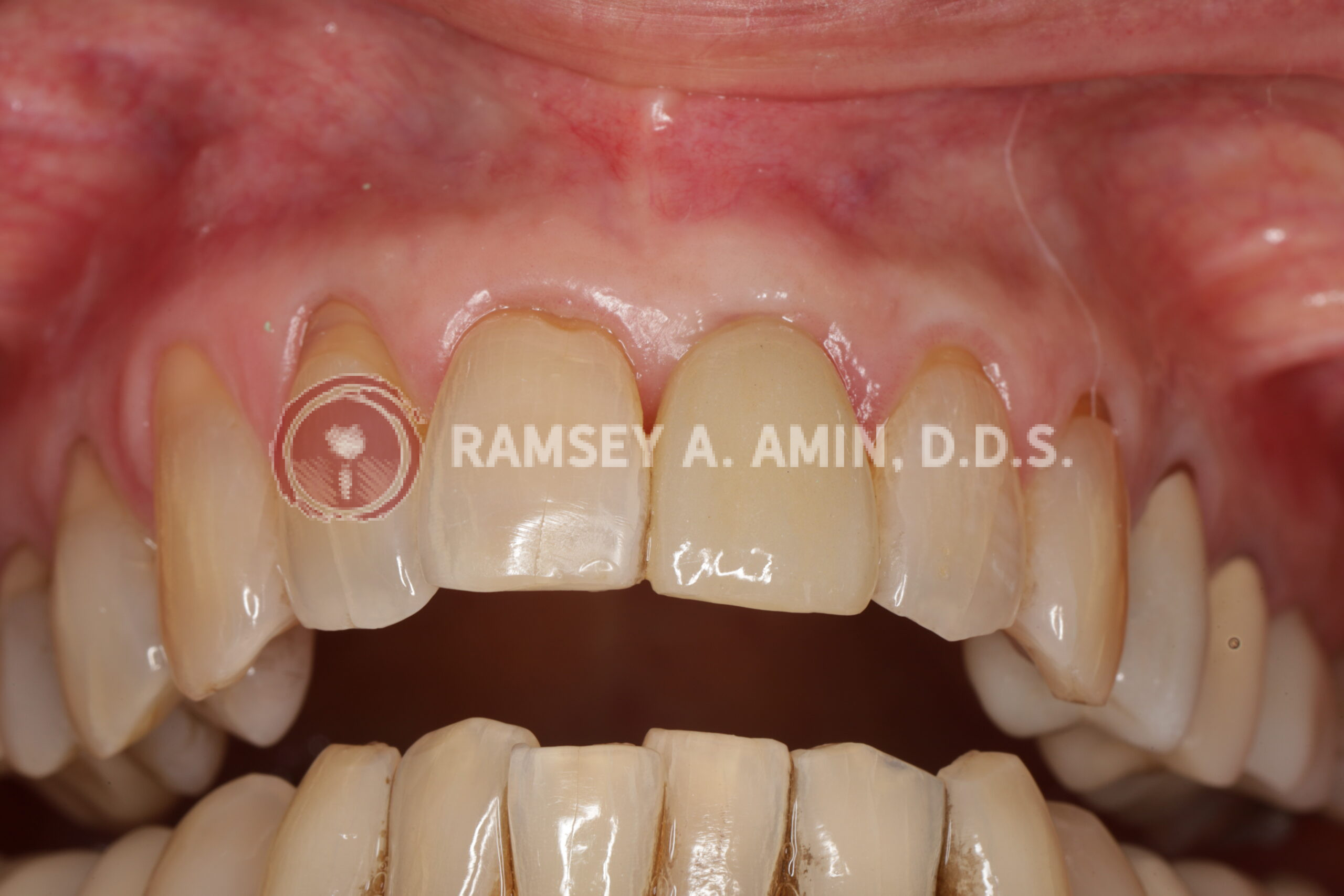 Final dental implant front tooth