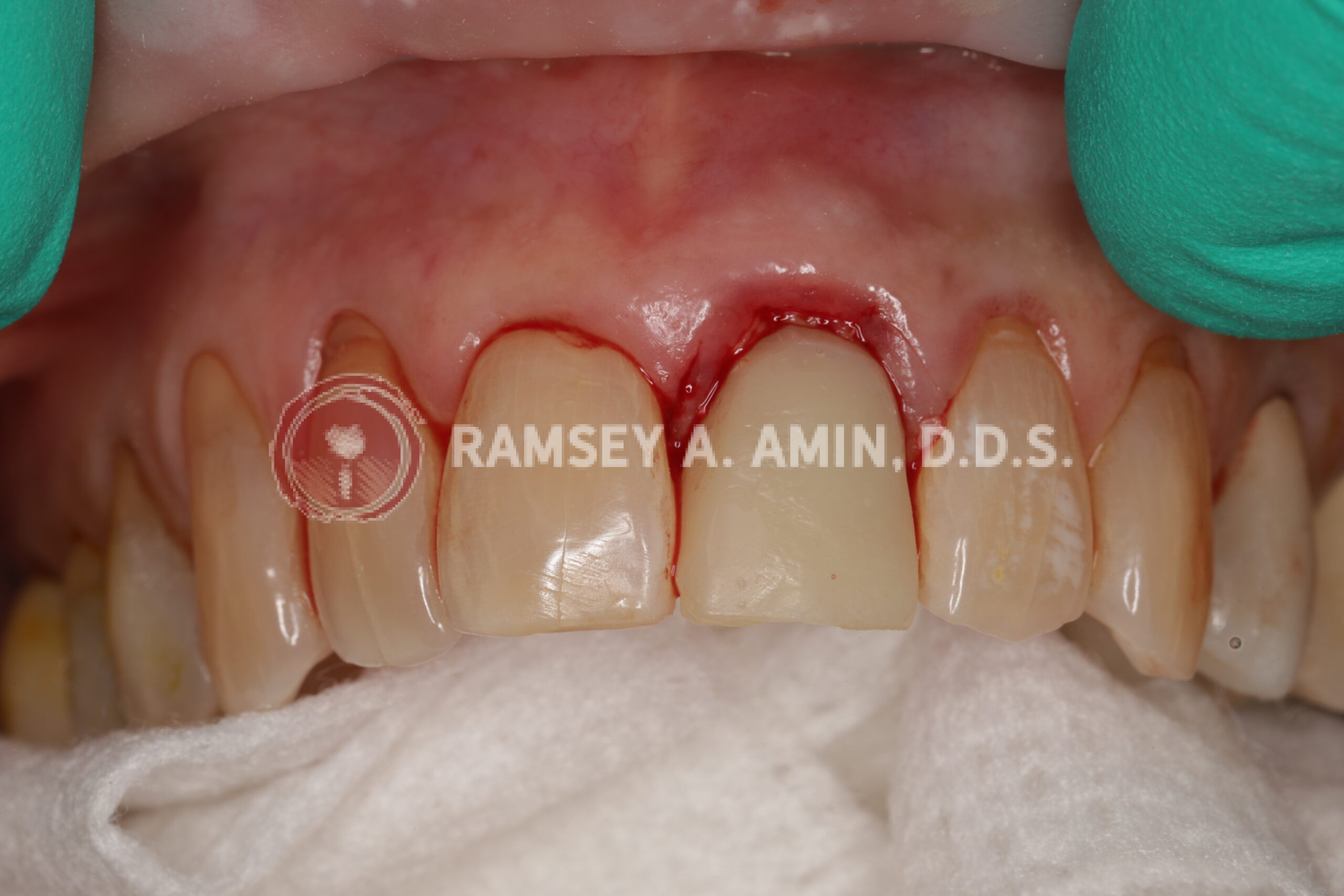 Natural tooth removed and temporary dental implant crown made-same day of surgery