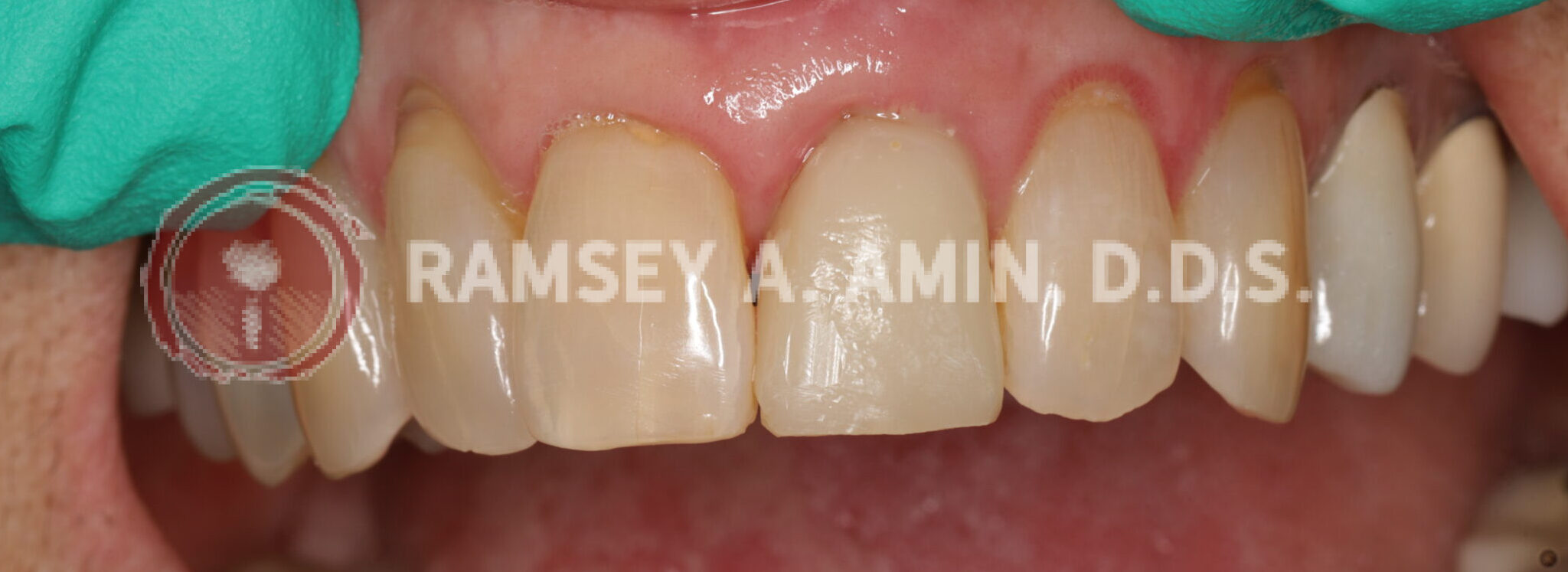 Natural tooth removed and temporary dental implant crown made-1 week after surgery with temp