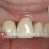 Dental implant with open black hole triangles