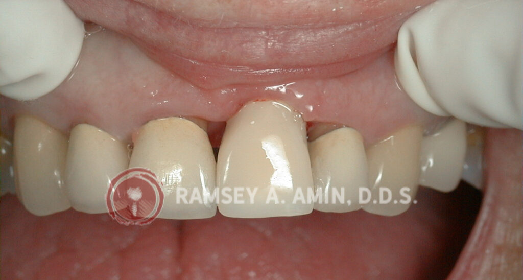 Dental implant with open black hole triangles