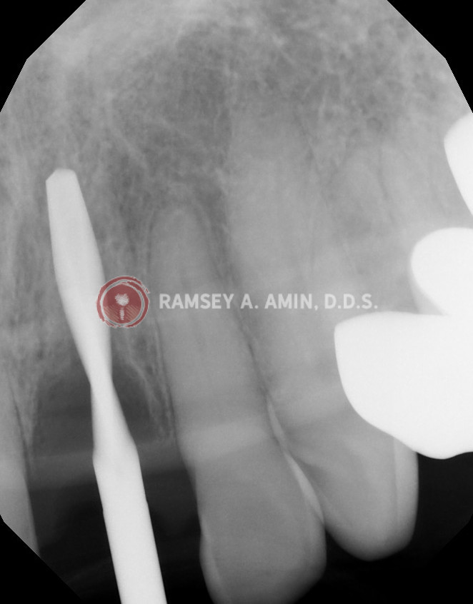 x-ray to guide implant into place after root extracted