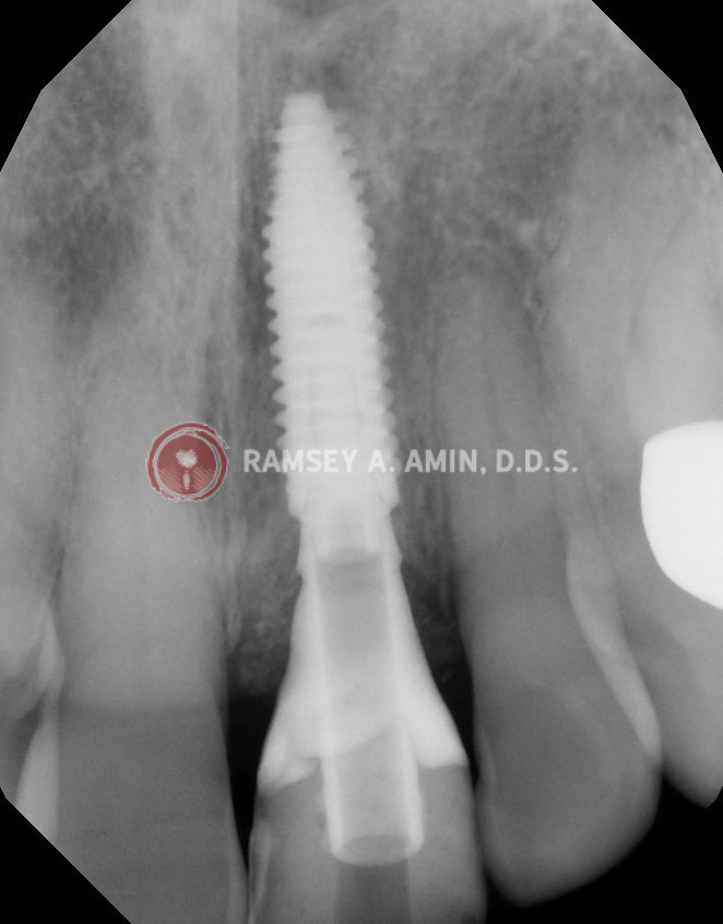 Same day screwed in temporary crown on dental implant