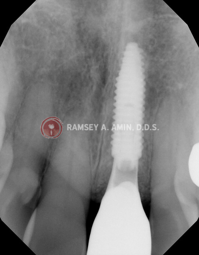Final dental implant front tooth x-ray showing excellent bone