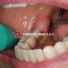 Jaw bone dying (MRONJ) next to dental implant.