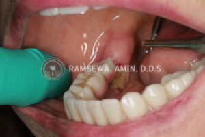 Jaw bone dying (MRONJ) next to dental implant.