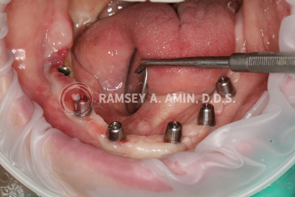 MRONJ Jaw bone dying (MRONJ) next to dental implant.