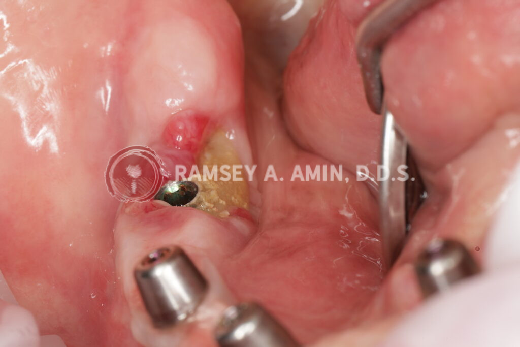 Jaw bone dying MRONJ Jaw bone dying (MRONJ) next to dental implant.