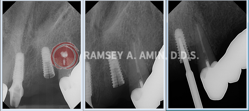 xray by Ramsey Amin DDS showing dental implant problems