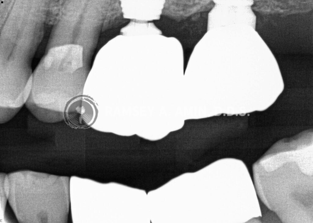 xray of implants by Dr. Ramsey Amin of Burbank Dental Implants