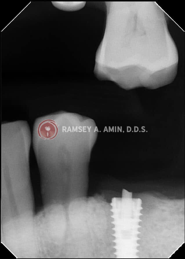 xray by Dr. Ramsey Amin of Burbank Dental Implants