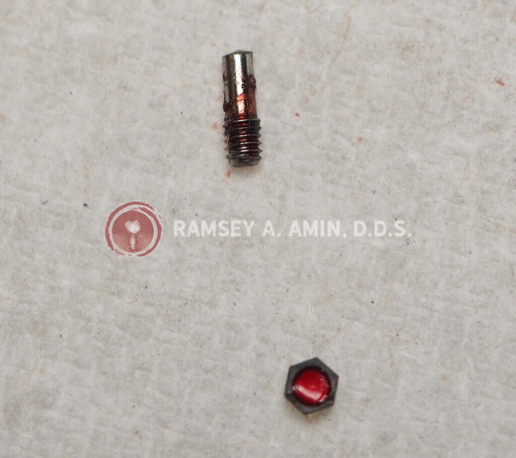 broken dental implant photo by Dr. Ramsey Amin of Burbank Dental Implants