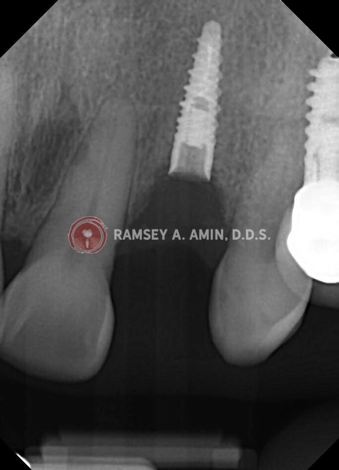 xray by Dr. Ramsey Amin of Burbank Dental Implants