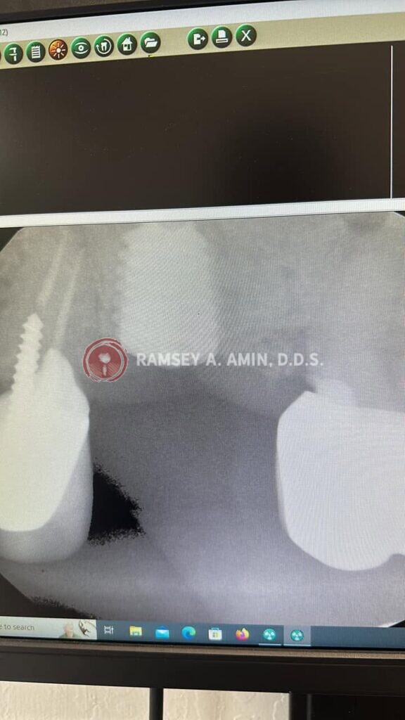 xray showing problem with implants by Dr. Ramsey Amin of Burbank Dental Implants