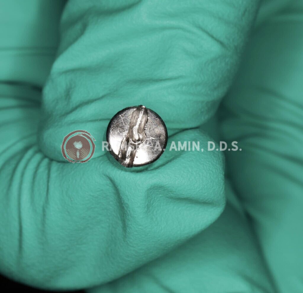 problem with dental implant screw photo by Dr. Ramsey Amin of Burbank Dental Implants