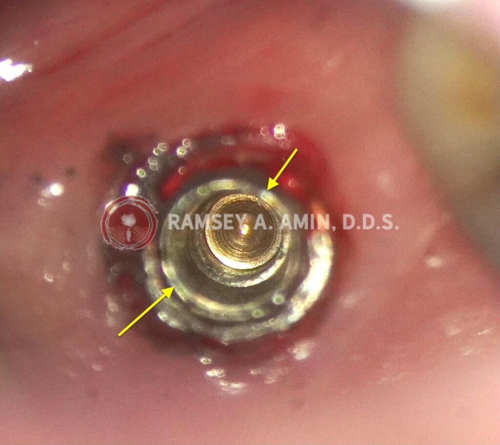 dental implant screw problem by Dr. Ramsey Amin